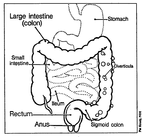 What is ulcerative colitis